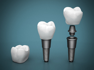 طقم برغي زرع أسنان قابل للتطبيق برغي طبي من التيتانيوم